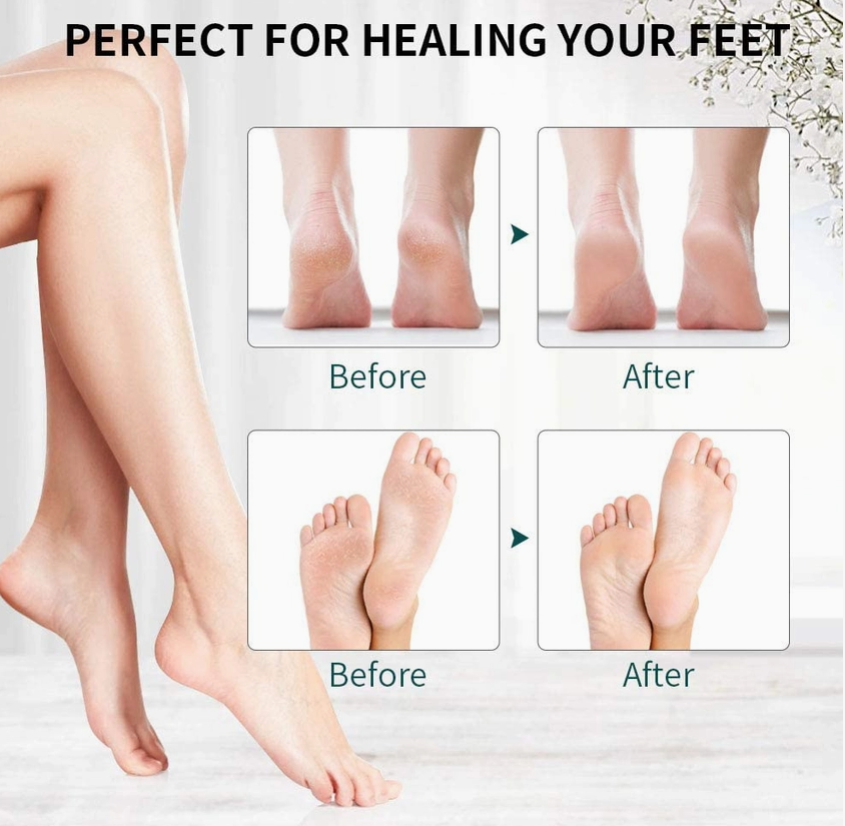 Rechargeable Electric Callus Remover – Electronic Foot File & Hard Skin Remover